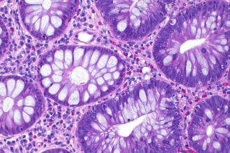 cum a ajuns cancerul de colon sa afecteze tot mai multi tineri si care este cauza principala indicata de studii 68e61cee6d9c8