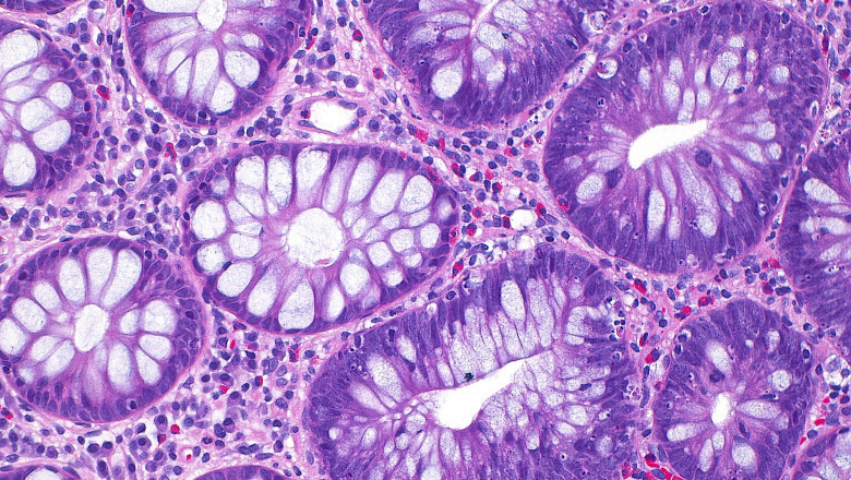 cum a ajuns cancerul de colon sa afecteze tot mai multi tineri si care este cauza principala indicata de studii 68e61cee6d9c8